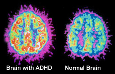 adhd-hersens-vs-normale-hersens